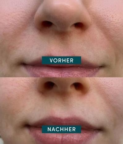 APRICOT Mouth patches with aloe vera Huulimaski 100 kpl