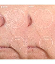 PMD Personal Microderm Pink Mikrodermabrasio 1 kpl