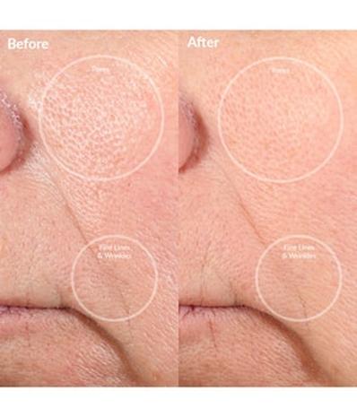 PMD Personal Microderm Pink Mikrodermabrasio 1 kpl