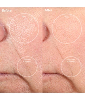 PMD Personal Microderm Pro Blush Mikrodermabrasio 1 kpl