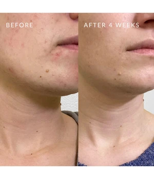 PMD Clean Acne Valoterapialaite 1 kpl