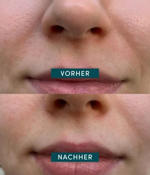 APRICOT Mouth patches with aloe vera Huulimaski 100 kpl